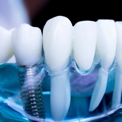 Mantenimento della protesi dentale su impianti