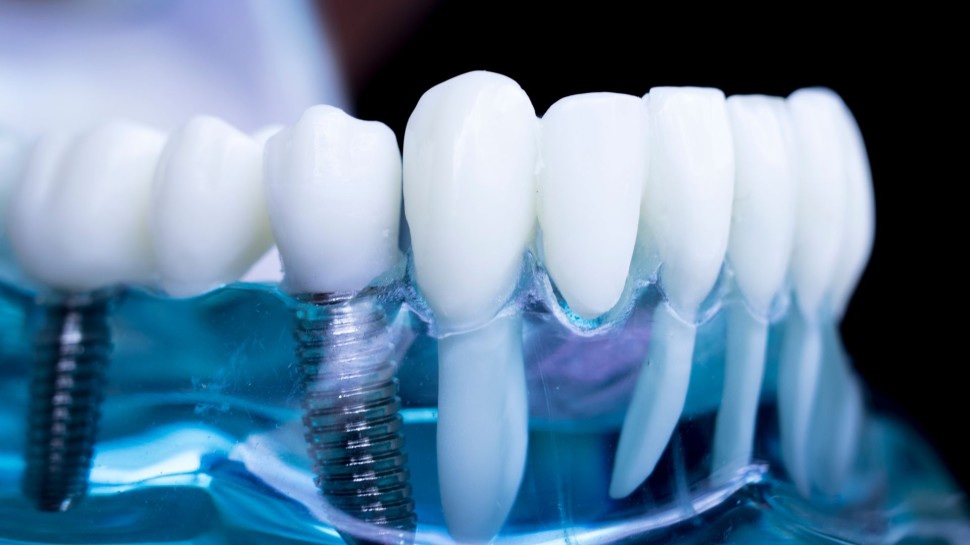 mantenimento protesi dentale